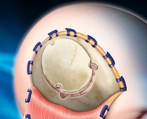 Clips de colgajo - Neurocirugia - PRIM Neuro-Trauma