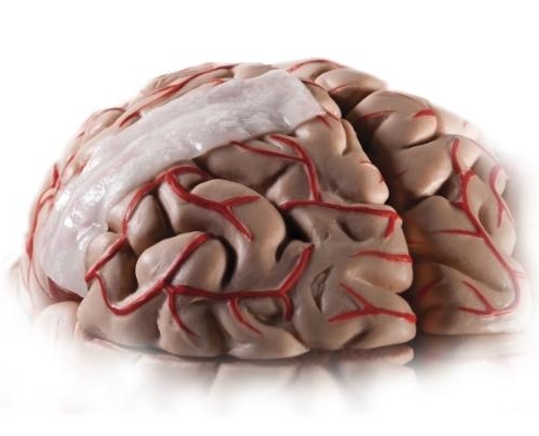 Plastia de duramadre - Neurocirugia - PRIM Neuro-Trauma