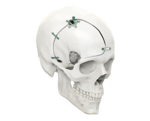 Sistema de cierre craneal- Neurocirugia - PRIM Neuro-Trauma